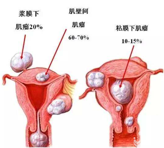 子宮肌瘤疾病會(huì)阻礙女性懷孕嗎？