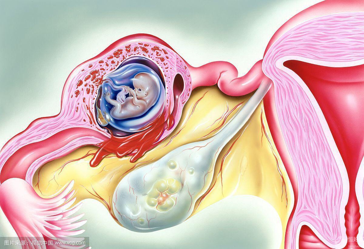 做試管嬰兒會發(fā)生宮外孕嗎？