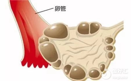 多囊卵巢適宜做試管嬰兒嗎？