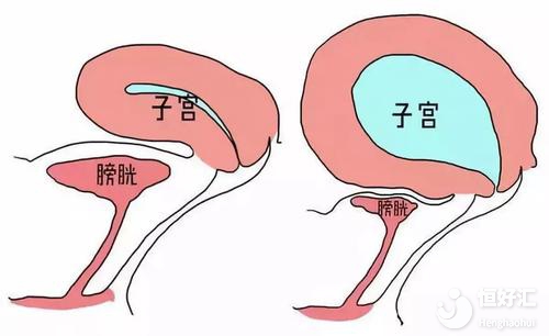 在胚胎移植前要憋尿？為什么？