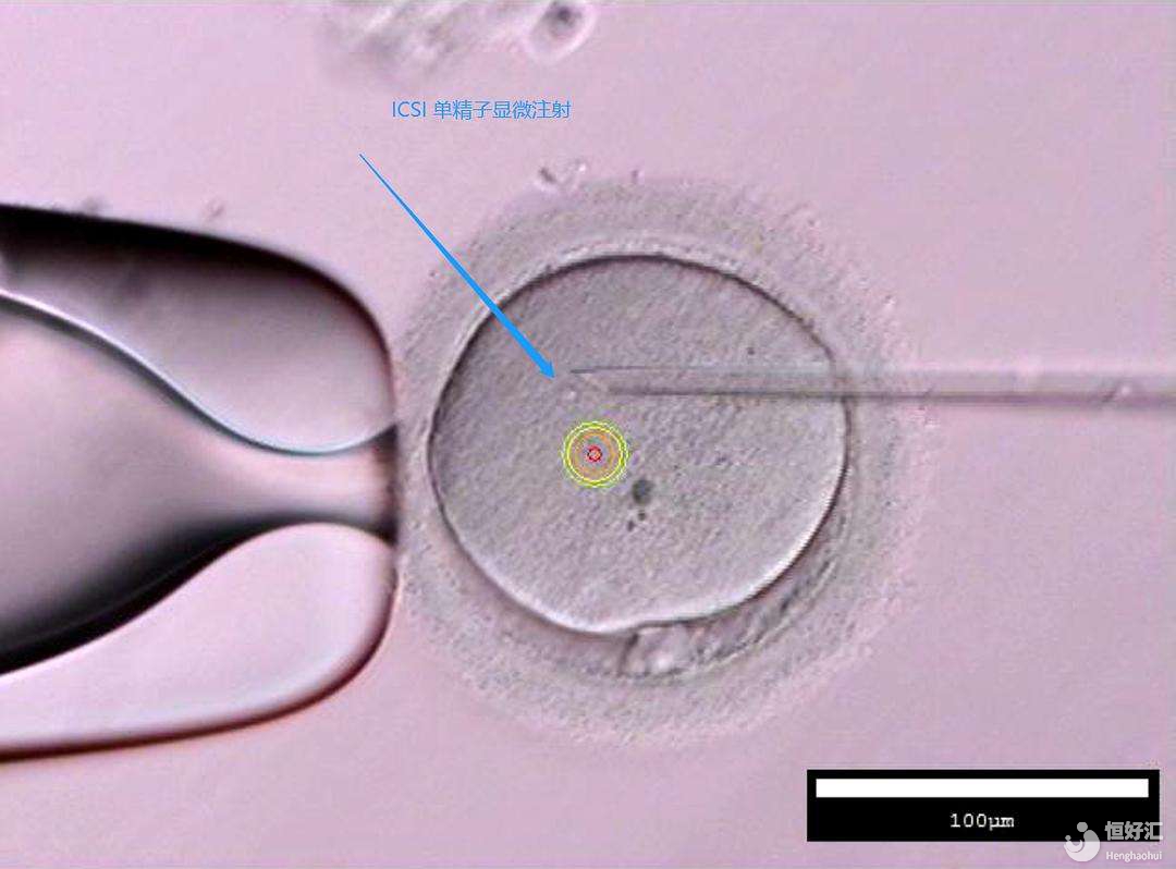 單精子卵泡漿細(xì)胞顯微注射技術(shù)是如何進行的呢？