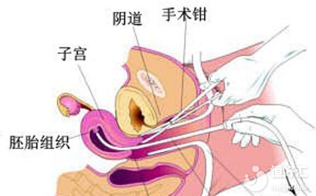 第一胎打胎的后果，看完你還敢亂來嗎？