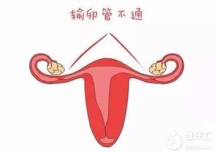 女性要能避開這3件事，或許能避免輸卵管堵塞