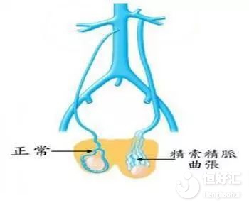 精索靜脈曲張