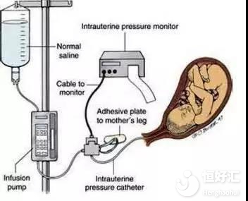 宮腔灌注能提高胚胎移植率？這些弊端了解一下