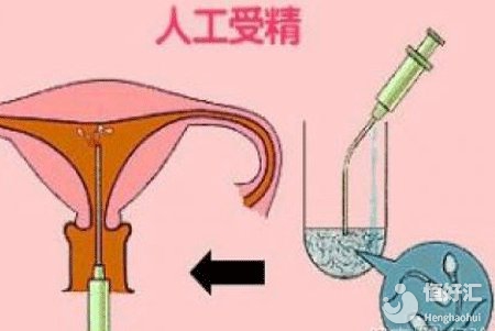 上海人工授精費用講解，這4大因素影響最終價格！