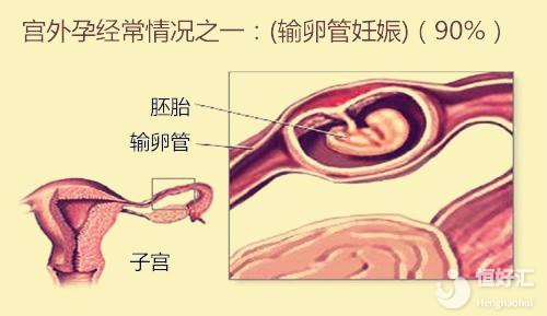 做試管嬰兒為什么也會宮外孕？其原因很常見