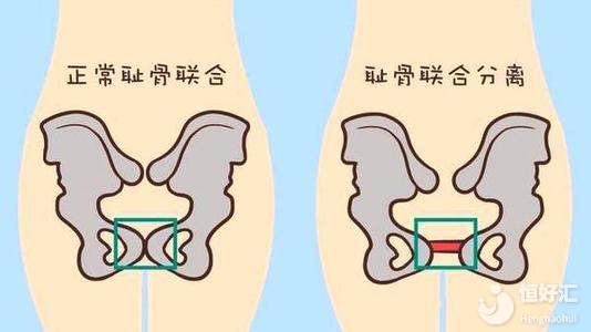 產后為什么會引起恥骨疼？這些緩解方法了解一下