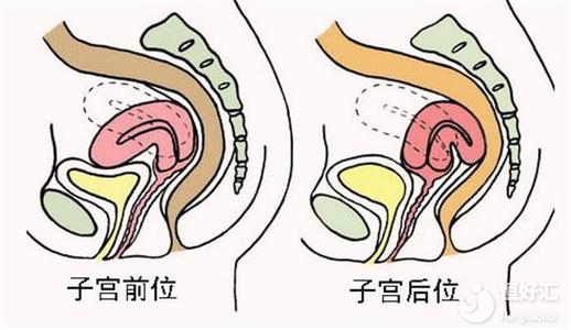 子宮后位或許會增加不孕幾率，這幾點問題請注意