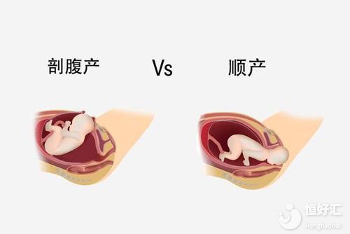 順產(chǎn)VS剖腹產(chǎn)最后誰(shuí)贏了？醫(yī)生：適合的才最好