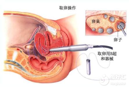 試管嬰兒取卵疼嗎？看完這個你可以放心了