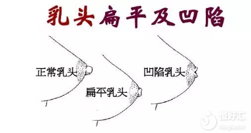 乳頭內陷如何喂奶？這些方法希望能幫到你