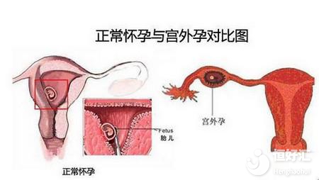 同是宮外孕為什么處理方式不一樣？這一點很關鍵