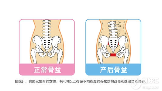 產(chǎn)后發(fā)生恥骨痛？掌握這些妙招助你趕走它