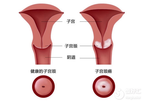 這3種子宮疾病容易引起不孕，快來看看你有嗎？