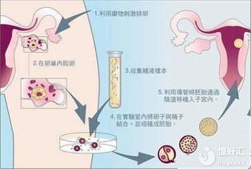 海外試管嬰兒有什么優(yōu)勢？這5點很明顯