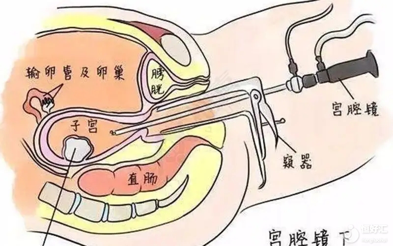 <strong>腹腔鏡跟宮腔鏡有什么區(qū)別？</strong>