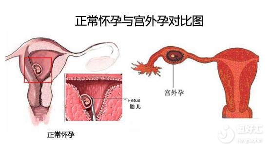 宮外孕征兆