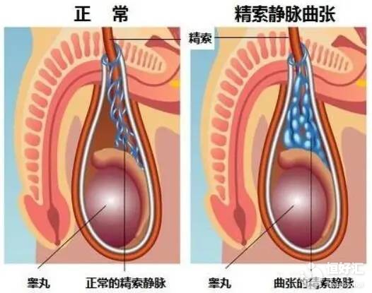 精索靜脈曲張治療