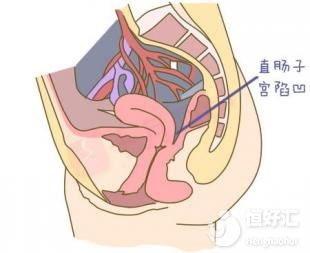 <strong>檢查發現有盆腔積液，需要治療嗎？</strong>