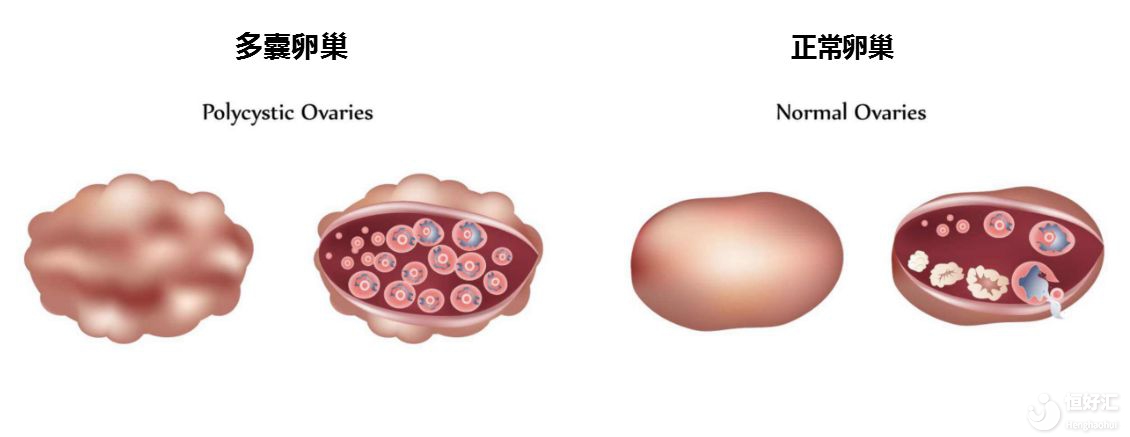 多囊卵巢綜合癥能自愈嗎？幾乎不能！