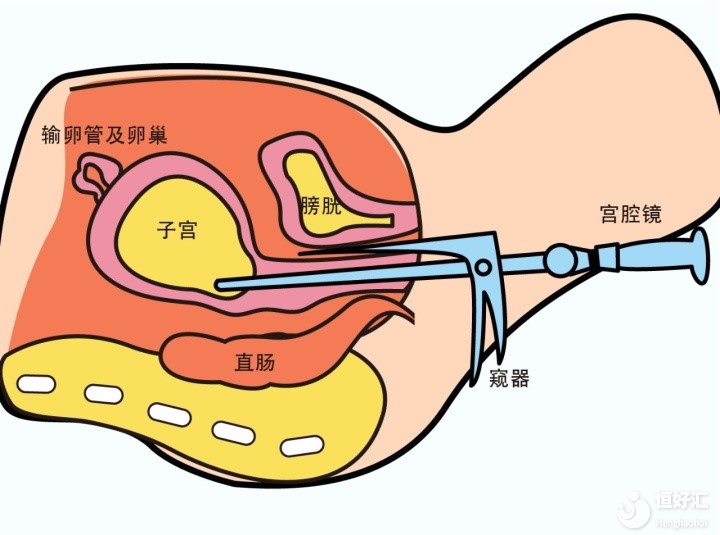 試管嬰兒移植前，為什么醫生會讓你去做宮腔鏡？