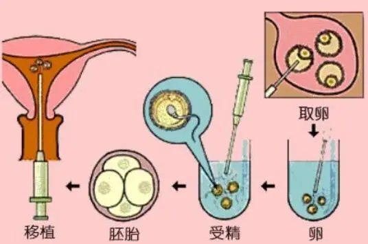 試管嬰兒是怎樣進行的，一張實拍圖告訴你，有些人想生個娃多不易