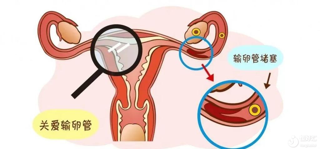 女性輸卵管堵塞的癥狀是什么？