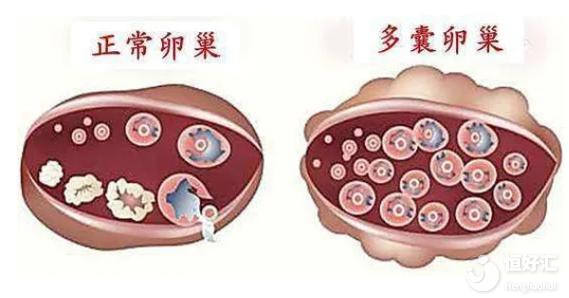 多囊卵巢不運(yùn)動不治療，會導(dǎo)致不孕？