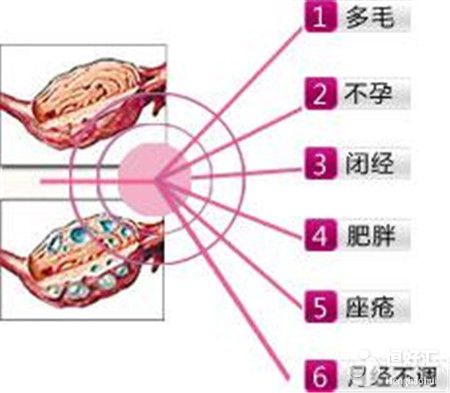 多囊卵巢綜合征，說白了就是一碗豬雜湯！