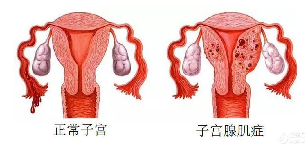 腺肌癥對懷孕的影響，你不會還不知道吧?