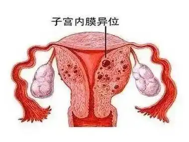 子宮內膜異位癥為什么會引發(fā)不孕？